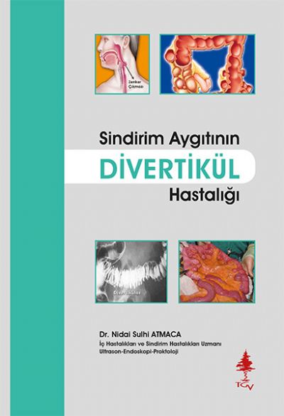 Divertikül